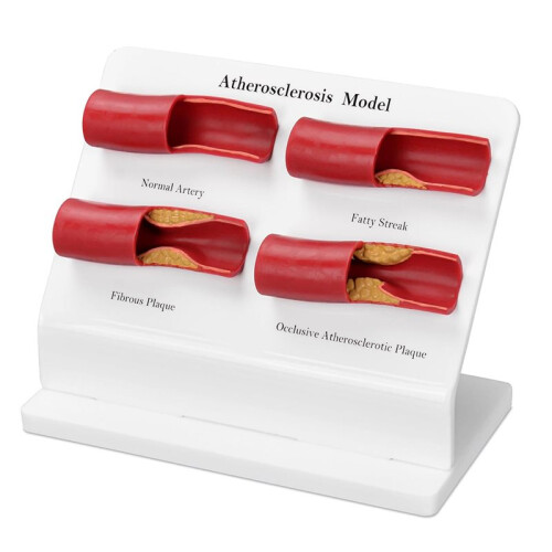 New Teaching Demonstration Model, Arterial Atherosclerosis Model, Vascular Model, Vascular Sclerosis Comparison Model