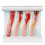 LDL Cholesterol Blood Vessel Model, 4-Stage Vascular Disease Teaching and Training Tool 1
