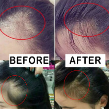 (10pcs) Ginger Hair Growth Shampoo Hair Loss Treatment Regrowth Serum For Men & Women