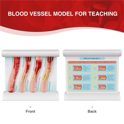LDL Cholesterol Blood Vessel Model, 4-Stage Vascular Disease Teaching and Training Tool 2