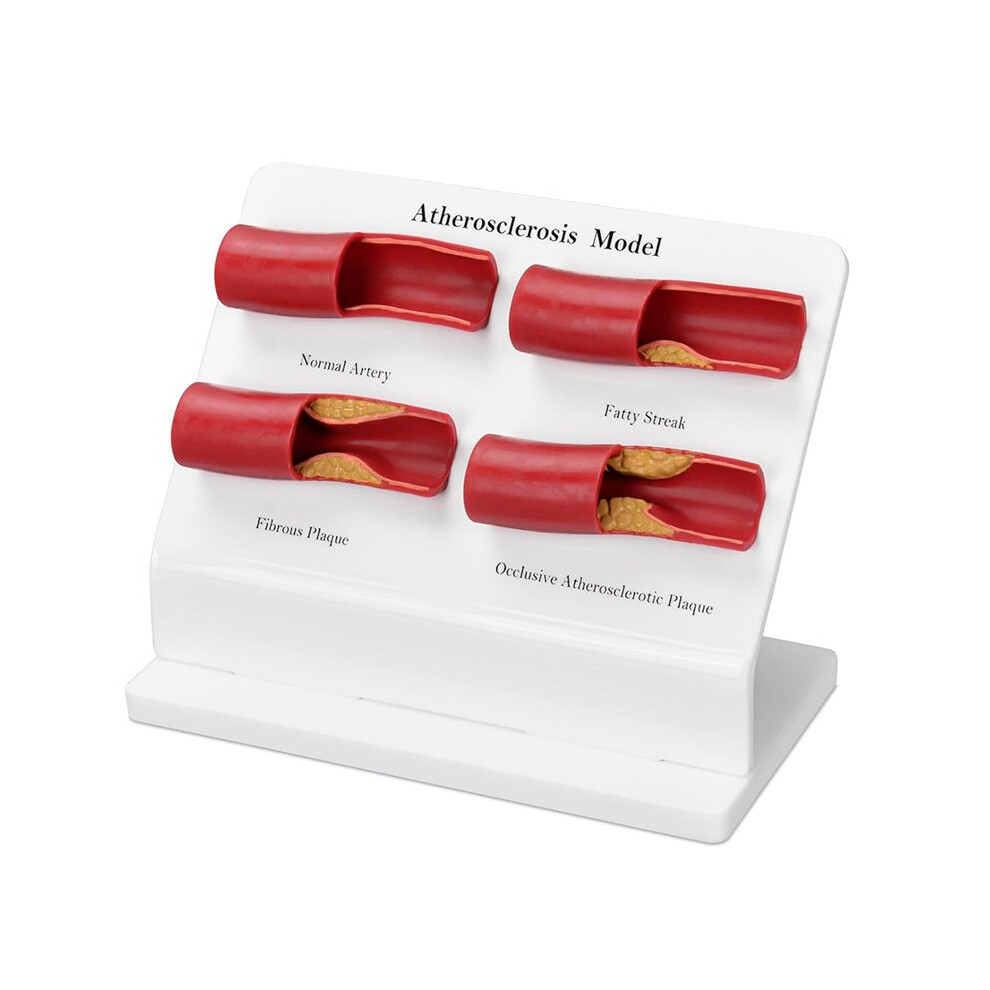 New Teaching Demonstration Model, Arterial Atherosclerosis Model, Vascular Model, Vascular Sclerosis Comparison Model