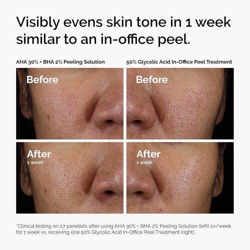 The Ordinary The Ordinary AHA 30% + BHA 2% Peeling Solution, Advanced Exfoliating Peel for Brighter Skin 2