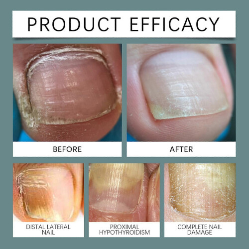 3PCS ProNail Complex Spray Oil for Nail 30ML 2