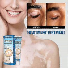 Natural Vitiligo Treatment Cream for Even Skin Tone and White Spot Reduction