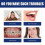 Jaw Alignment Brace 2