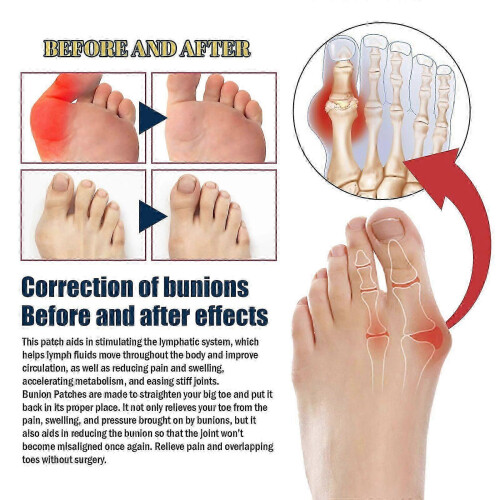 Bunion Relief Patch  Natural Extracts for Pain  Swelling Relief, 5pcs 2