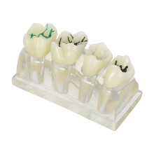 Caries Dents Transparent ABS Pour Formation Orale