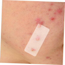 XL Akne Pimple Patches 3 kpl Näkymättömät Imevät Peitetarrat Sopii Epäpuhtauksien Poistoon