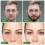 (0.3MM) Beard Roller, Dermaroller, Bartroller Bartwuchs, Microneedling Roller für Gesicht und Körper, Nadelroller Bart Roller 6