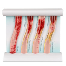 LDL Cholesterol Blood Vessel Model, 4-Stage Vascular Disease Teaching and Training Tool