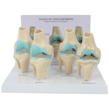 Kit de Genou Modèle D'Anatomie de L'Arthrose avec Carte-Clé Éducative Modèle de Genou en 4 Étapes Aides Pédagogiques Orthopédiques
