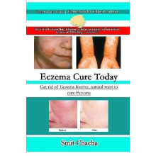 Eczema Cure Today - Get rid of Eczema forever natural ways to cure Eczema