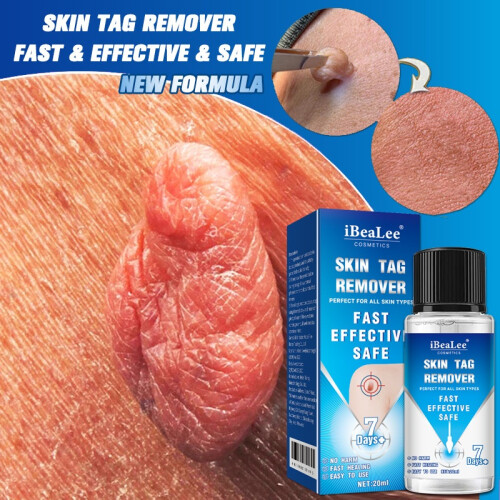 Skin Tag Remover Fast Effective Safe 20ml