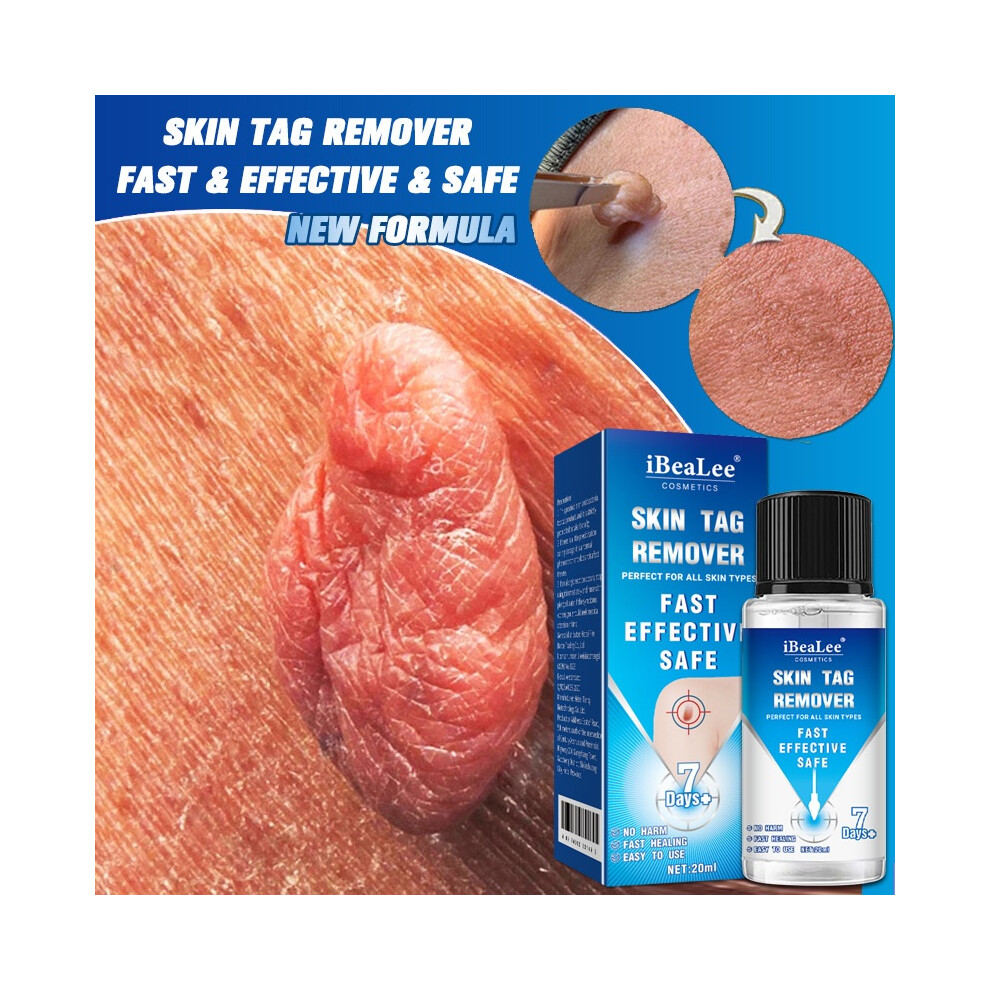 Stoyotu Skin Tag Remover Fast Effective Safe 20Ml