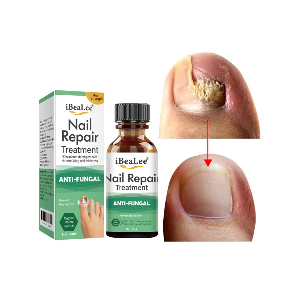 Stoyotu Nail Fungus Care Solution Essence Anti Fungal Foot Nails Repair Anti-Infection Onychomycosis Repairhand Foot Nail Care Treatment