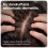 Sons Ketoconazole Shampoo & Sons Minoxidil 5% 6