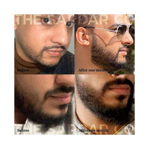 Derma Roller for Hair & Beard Growth - Microneedling 0.3mm 2
