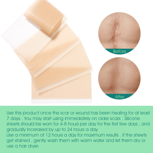 Scar Patches Small Size Scar Patches 4 Patches/box 2