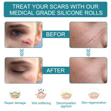 Scar Roll Self-adhesive Scar Patch 1.5m