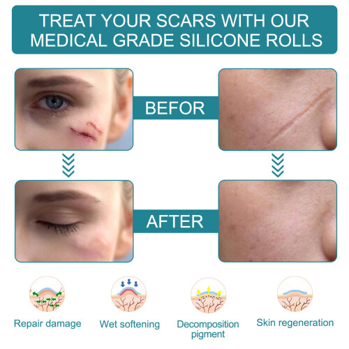Scar Roll Self-adhesive Scar Patch 1.5m
