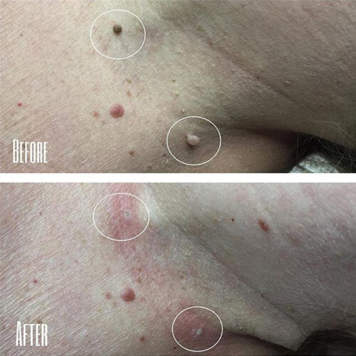 Skin Tag Remover Fast Effective Safe 20ml 1