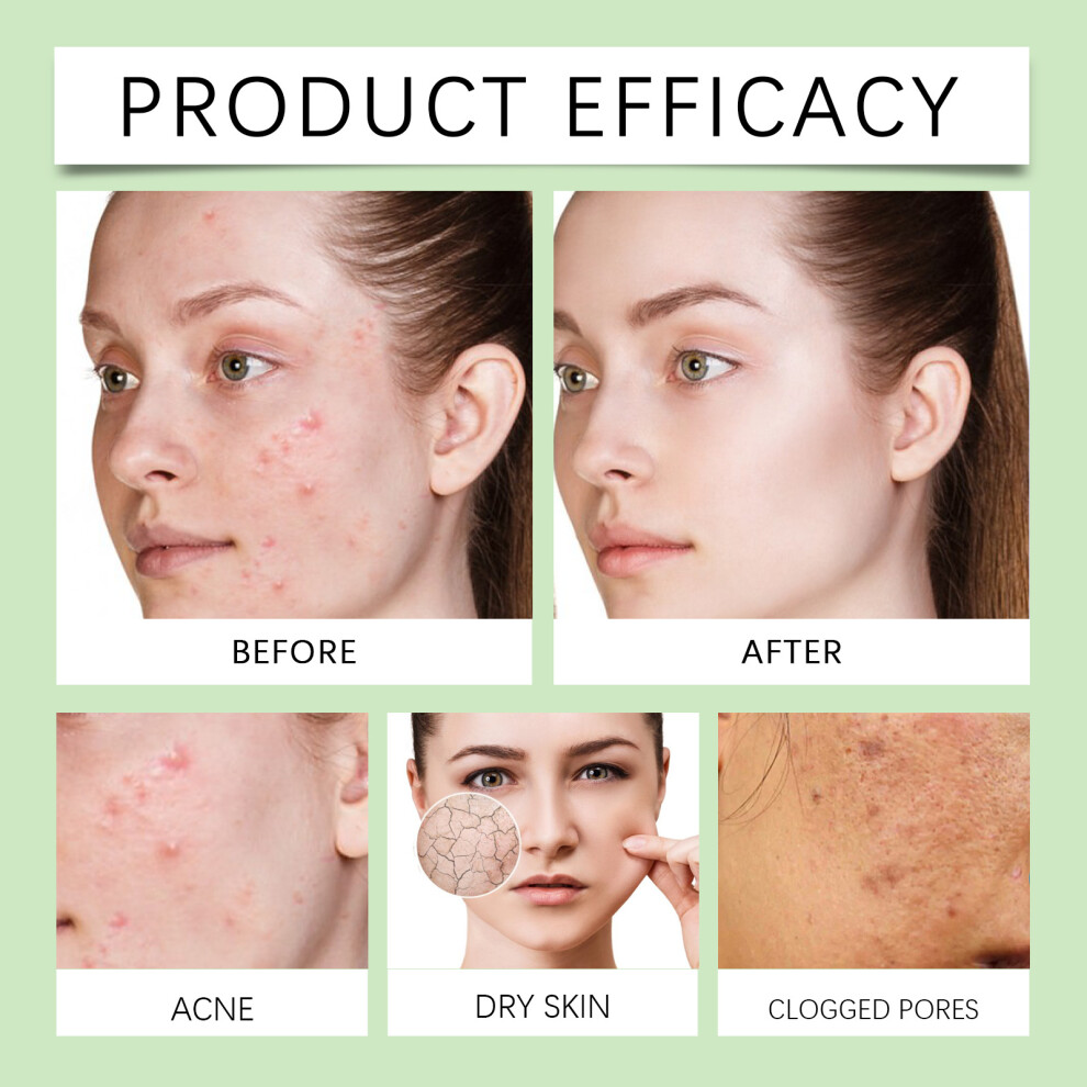 Cream Ouhoe Acne Moisturizing Skin Gentle Care