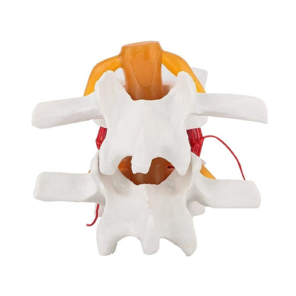 Human Anatomical Lumbar Disc Herniation Model 1.5 Times Life Size Lumbar Spine Model for Teaching and Learning