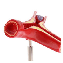 Menschliches Atherosklerose-Herz-Kreislauf-Modell Gefäßanatomie-Modell Zweig Atherosklerose Lehrmittel