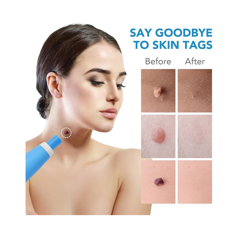 Stoyotu Skin Tag Removal Kit - Fast-Acting Safe And Effective Skin Tag Remover For All Skin Types -With 40 Removal Bands & 10 Cleansing Wipes