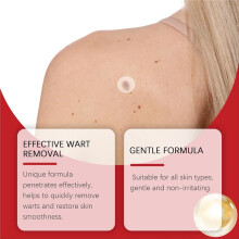 (RED) 180PCS Skin Tag Removal Patches – Tag Remover Stickers for Face Finger Arm and Leg, Adhesive Spot Covers Mole Remover