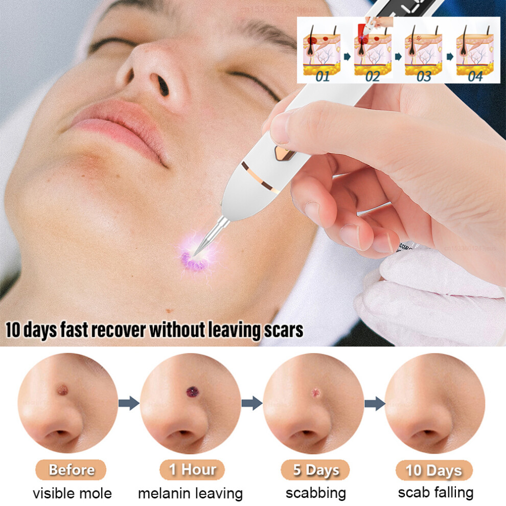 Stoyotu Black/Dark Laser Plasma Pen Warts Remover Dots Wart Eliminator Skin Tag Remover Freckles Papilloma Mole Wart Nevus Spots Remover