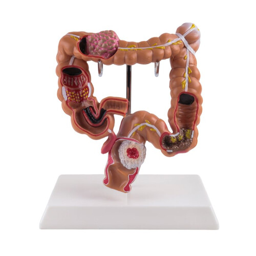 Teaching Model,Human Large Intestine Anatomy Model Visceral Lesion Model Human Digestive System Learning Model