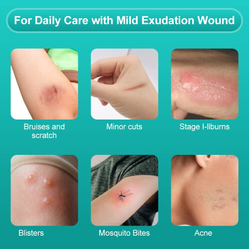 Dimora Hydrocolloid Dressing – Waterproof, Self-Adhesive Wound Patches for Burns 2