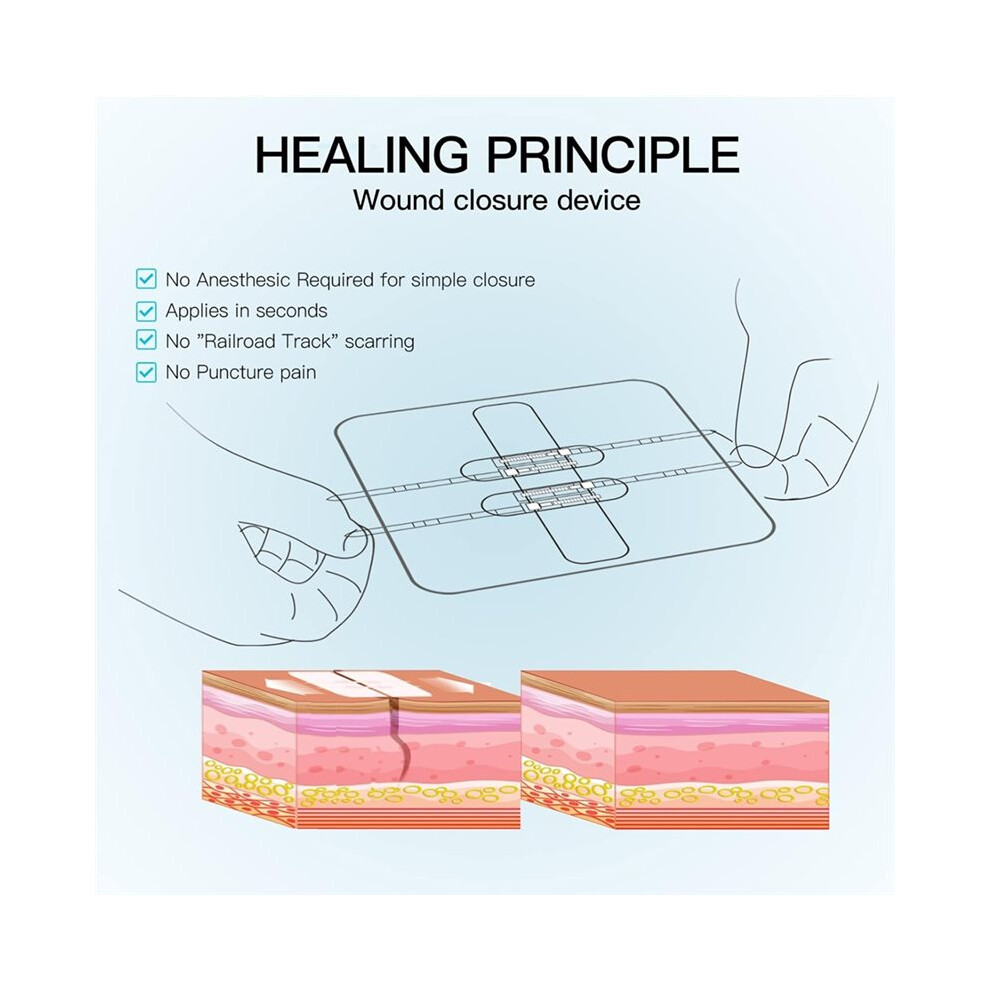 10PCS Laceration Repair Without Stitches Butterfly Bandaids Quick Clot - Emergency Wound Closures Device