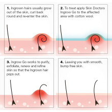 Skin Doctors Ingrow Go Lotion | Ingrown Hair Treatment | Reduces