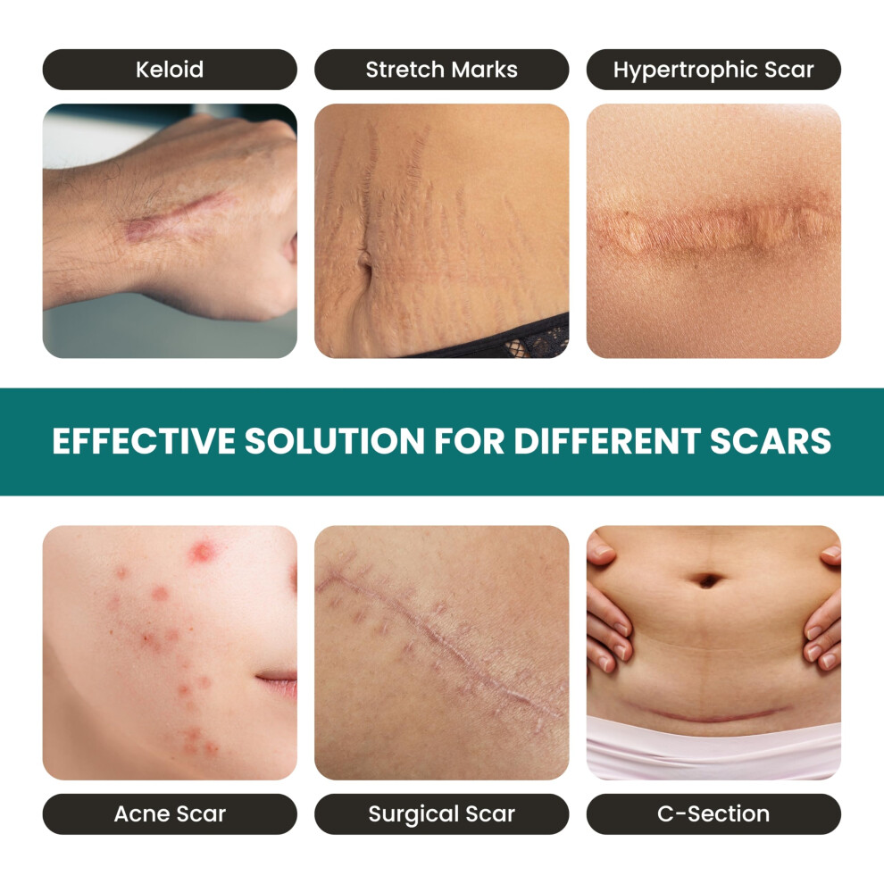 Reliantpro Waterproof Silicone Scar Tape - Hypoallergenic Medical Grade Silicone Scar Sheets, Ultra-Soft Scar Tape For Surgical Scars, C Section Reco