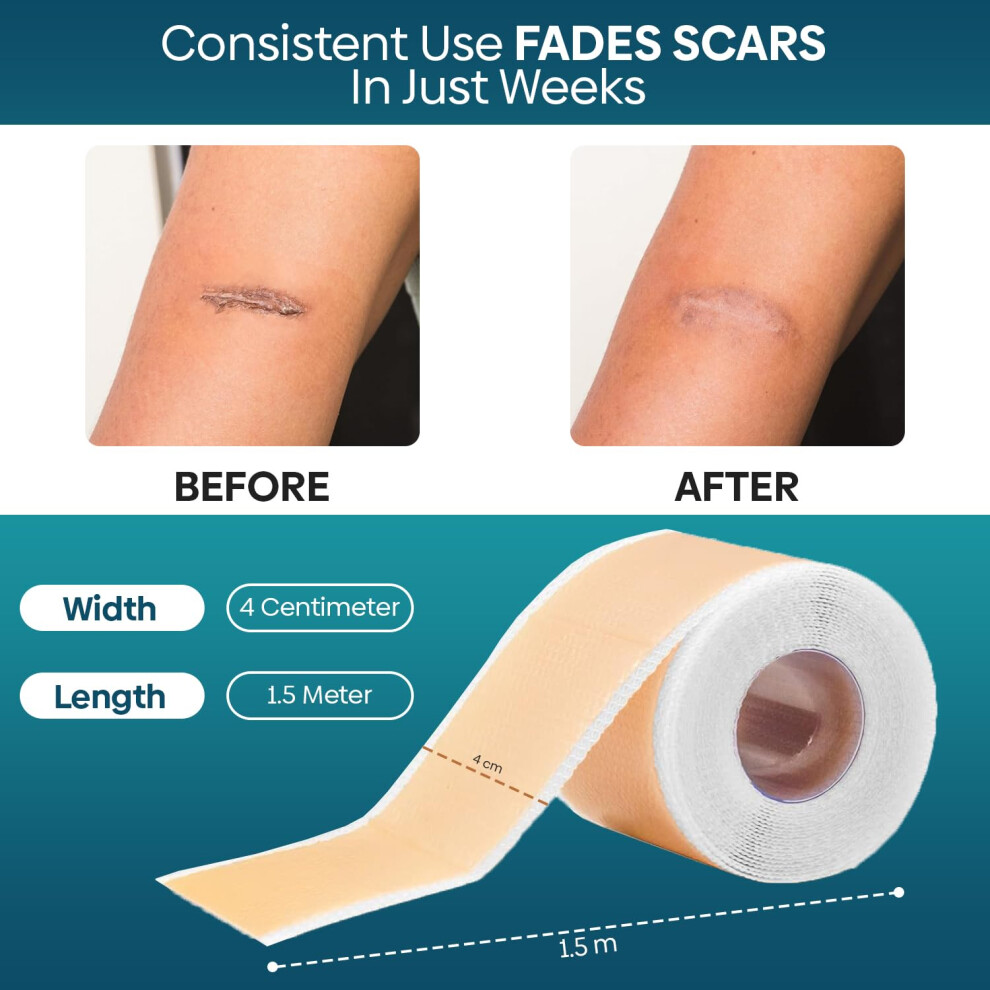 Zalvix Silicone Scar Tape Medical Grade Silicone Scar Sheets | 4Cm X 1.5M |