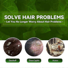 Scalp Ringworm Anti-itch Shampoo Dandruff Control Oil Anti-itch Shampoo Anti-loss Oil Control Refreshing Shampoo 100ml