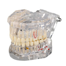 Transparent Disease Teeth Model with Dental Implant Bridge, Dental Model for Patient and Dental Student Education