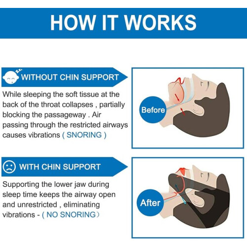 Hetang Yuese Anti-snoring chin strap, chin strap, protective
