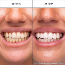 (5boxes) V34 Whitening Strips, Teeth Whitening Strips, Purple Tooth Whitening, Tooth Stain Treatment, Combining Whitening and Colour Correction