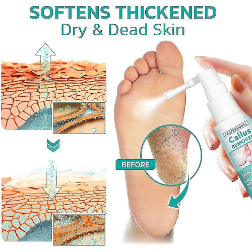 5g Professional Callus Remover Extra Strength Spray, Instant Foot Peeling Spray 2