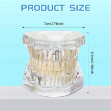 3X Model Zębów Chorobowych Typodonty Dentystyczne Implant Zębów Model z Zębami Ruchomymi Demonstracja Standardowego Zęba Dentysty
