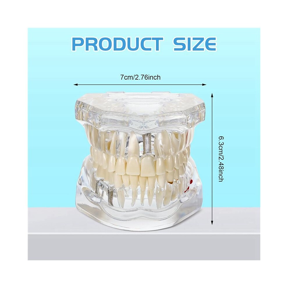 3X Disease Teeth Model Dental Typodonts Implant Teeth Model with Removable Teeth Dentist Standard Tooth Demonstration