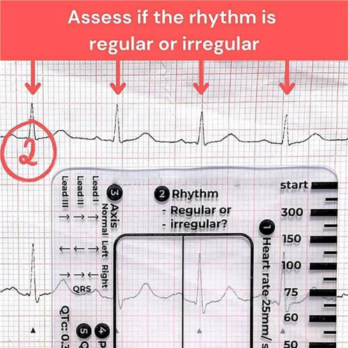 16pcs ECG 7 Step Ruler,ECG 7 Step Ruler for ECG/EKG Interpretation,ECG Reference Guide Ruler,EKG Calipers Measuring Tool