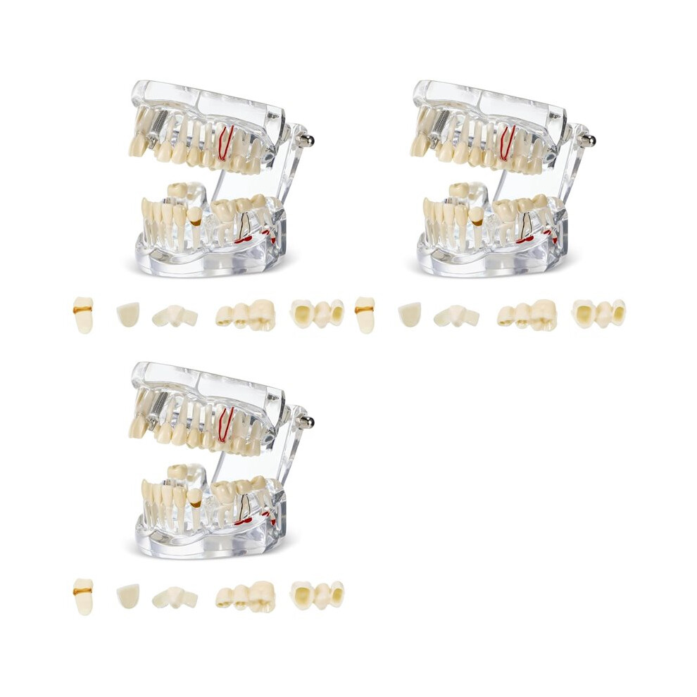 3X Disease Teeth Model Dental Typodonts Implant Teeth Model with Removable Teeth Dentist Standard Tooth Demonstration