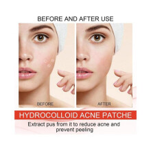 Pimple Patch Hydrocolloid Plaster for Absorbing Acne Pimples 144Pcs Hydrocolloid Pimple Patch