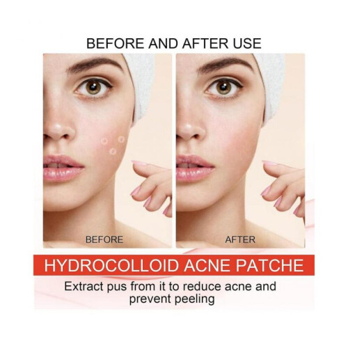 Pimple Patch  Hydrocolloid Plaster for Absorbing Acne Pimples 144Pcs Hydrocolloid Pimple Patch