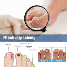 Nail Repair Patch, Hands And Feet Soft Nail Inlaid Nail Thickening Bright Nail Furrow Gray Nail Care Patch