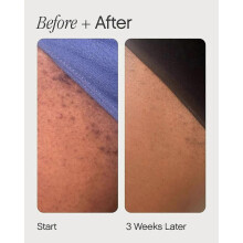 (2PCS) 1-5x High Roller Ingrown Hair Serum | Roll-on Tonic to Soothe and Calm Irritated Skin on Face, Armpits and Bikini Areas